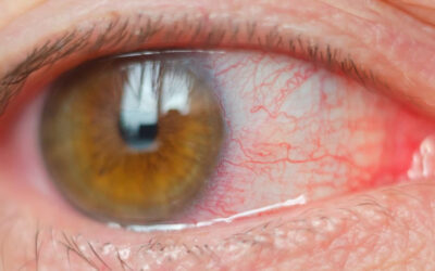 Conjunctivitis